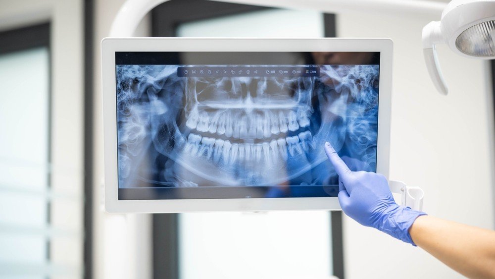 Dental x rays