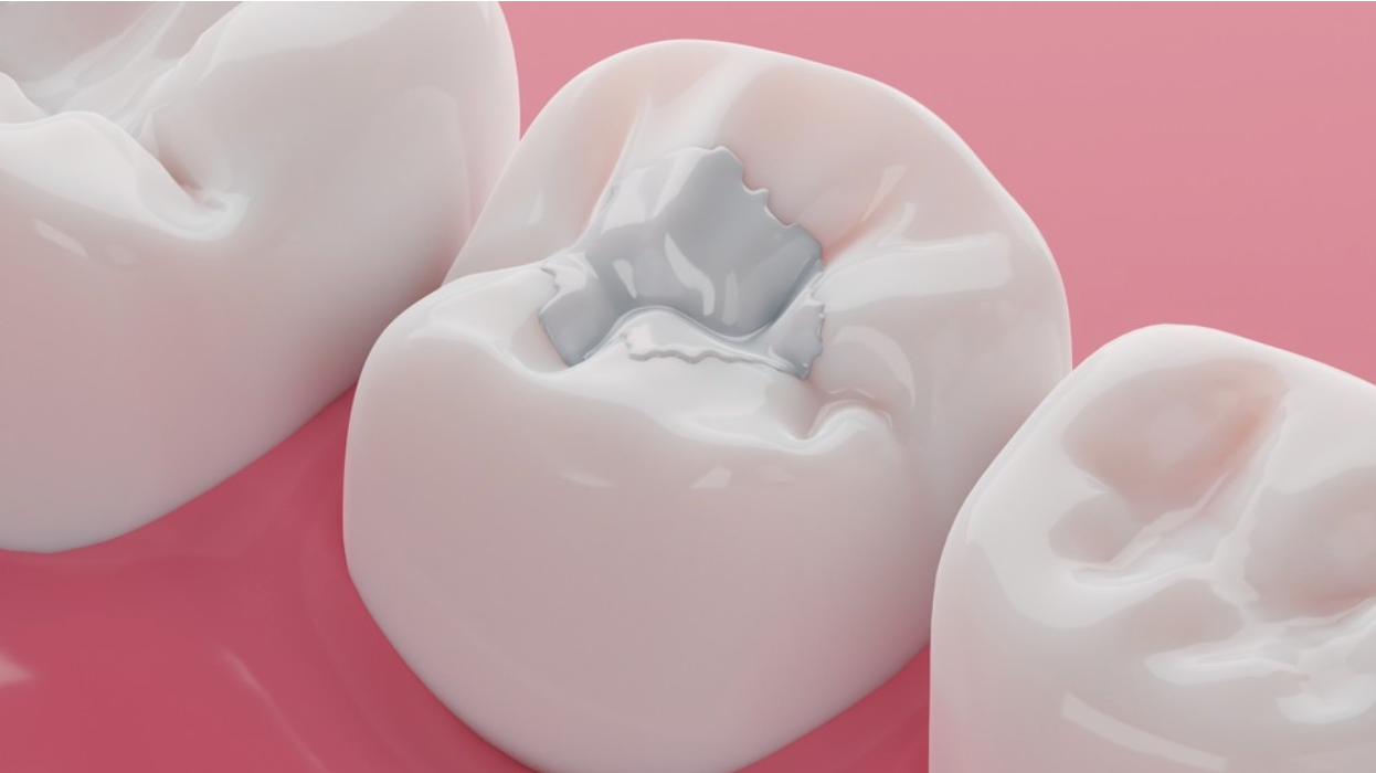 Composite Fillings
