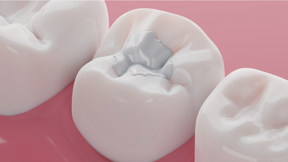 Composite Fillings
