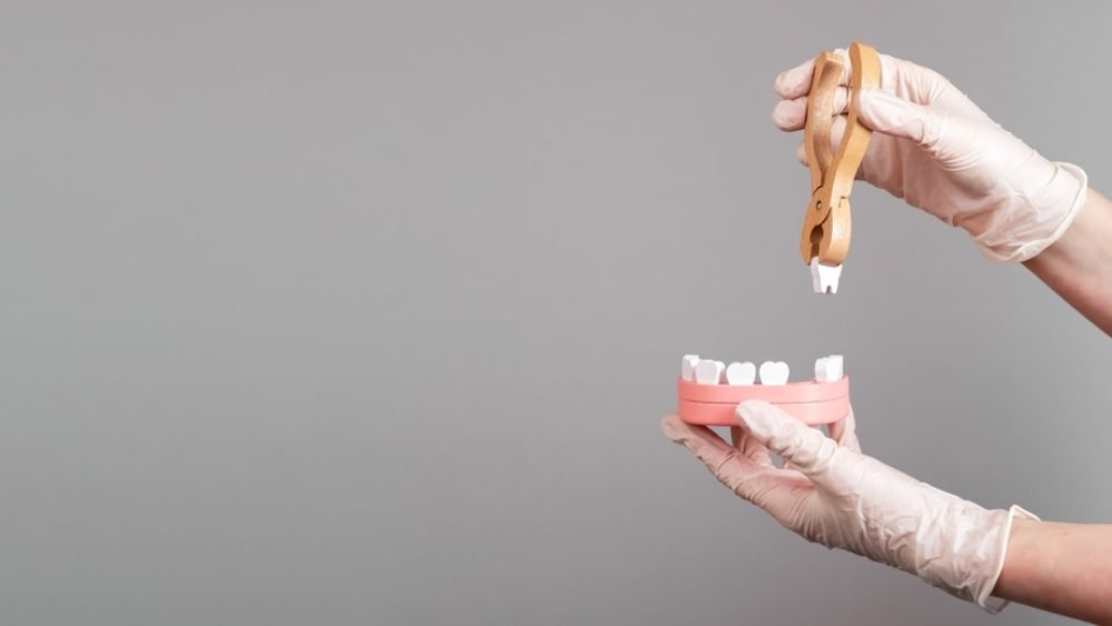Tooth Removal